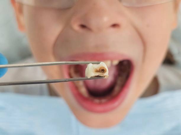 Best Emergency Treatment for Dental Infections or Abscesses in Acton, CA